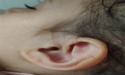 Parkta 3 yaşındaki çocuğun kulağına kene yapıştı