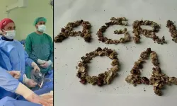 Operasyonu geçiren hastadan 295 taş çıkarıldı