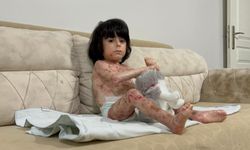 Kelebek hastalığı nedeniyle kıyafet giyemiyor