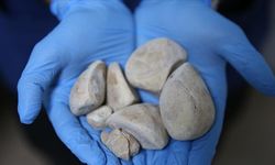 Mesanesinden yarım kilo taş çıkarıldı