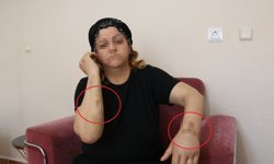 Yaralanan kadın tedavi sonrası şikayetçi oldu