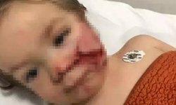 Pitbull saldırısında yeni gelişme