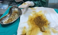 Safra kesesinden 2 bin 67 taş çıkarıldı