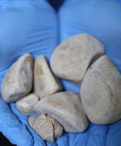 Mesanesinden yarım kilo taş çıkarıldı