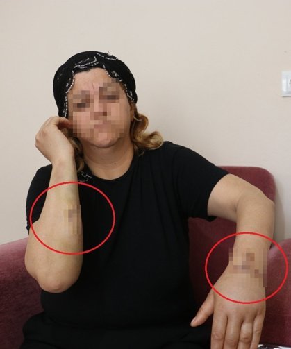 Yaralanan kadın tedavi sonrası şikayetçi oldu