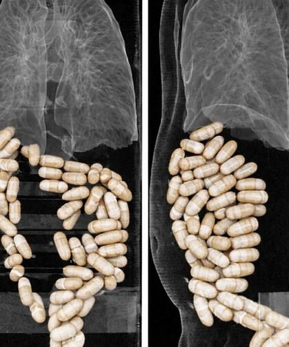 Şüphelilerin midesinden 127 kapsül yasaklı madde çıktı