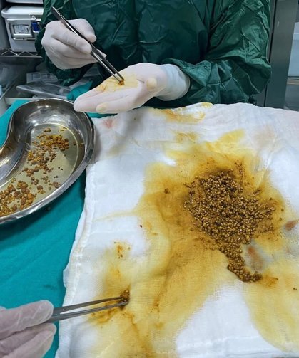 Safra kesesinden 2 bin 67 taş çıkarıldı