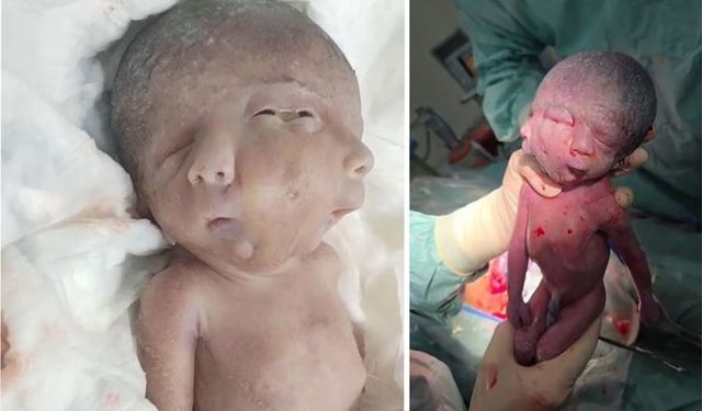 Aynı vücudu paylaşan iki yüzlü ikiz bebek dünyaya geldi