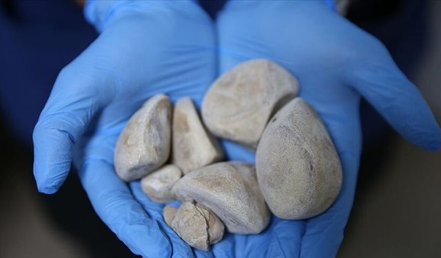 Mesanesinden yarım kilo taş çıkarıldı