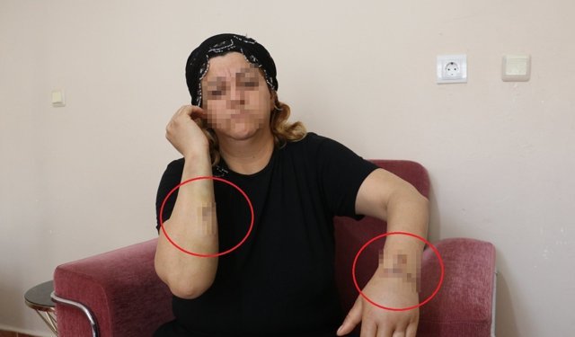 Yaralanan kadın tedavi sonrası şikayetçi oldu
