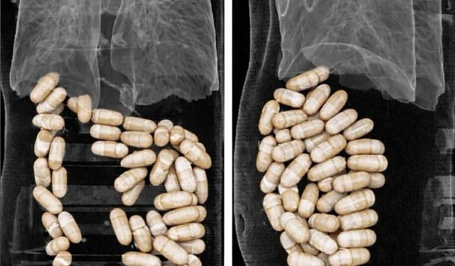 Şüphelilerin midesinden 127 kapsül yasaklı madde çıktı