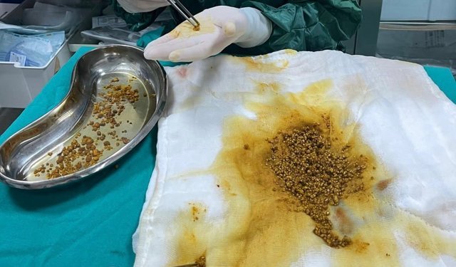 Safra kesesinden 2 bin 67 taş çıkarıldı