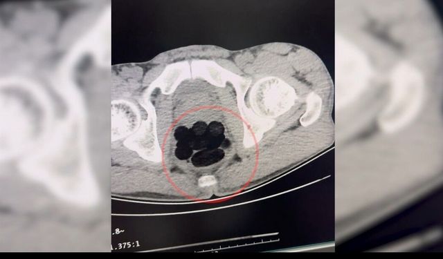 Midesinden uyuşturucu çıkan şüpheli, tutuklandı
