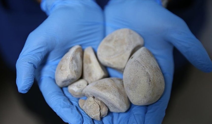 Mesanesinden yarım kilo taş çıkarıldı