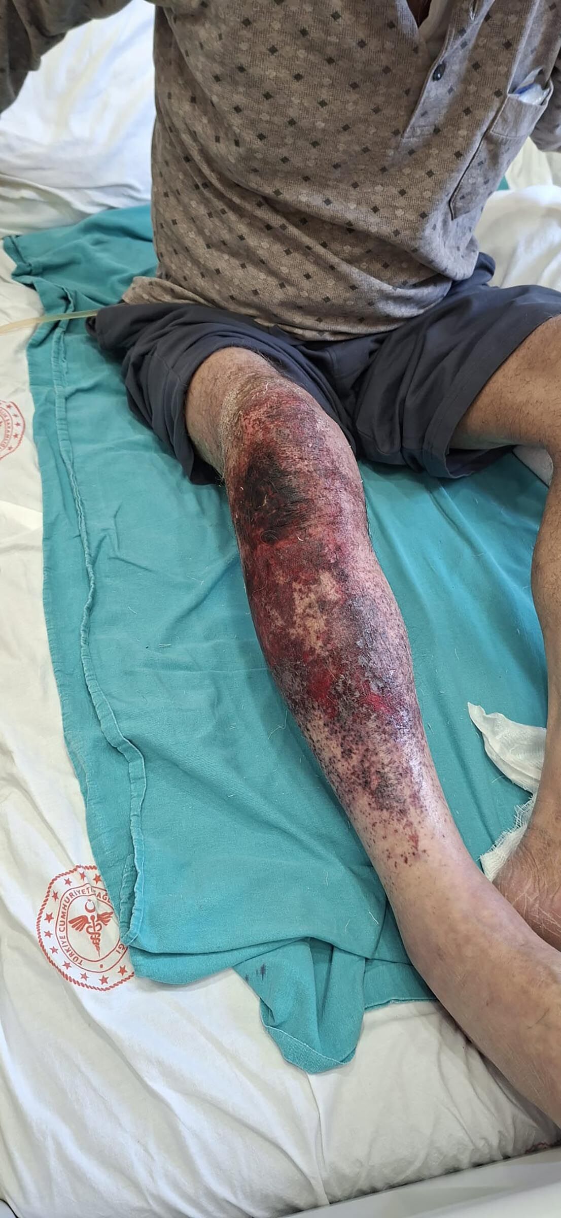 Lavaboyu açmaya çalıştı, kimyasal yanıkla hastanelik oldu